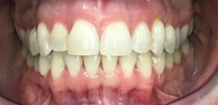 Invisalign Case 5 after