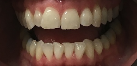 Invisalign Case 5 before