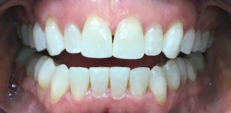 Invisalign Case 6 after