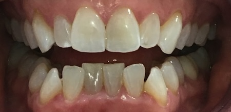 Invisalign Case 6 before