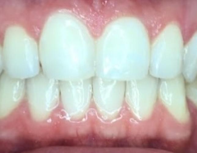 Invisalign Case 2 after