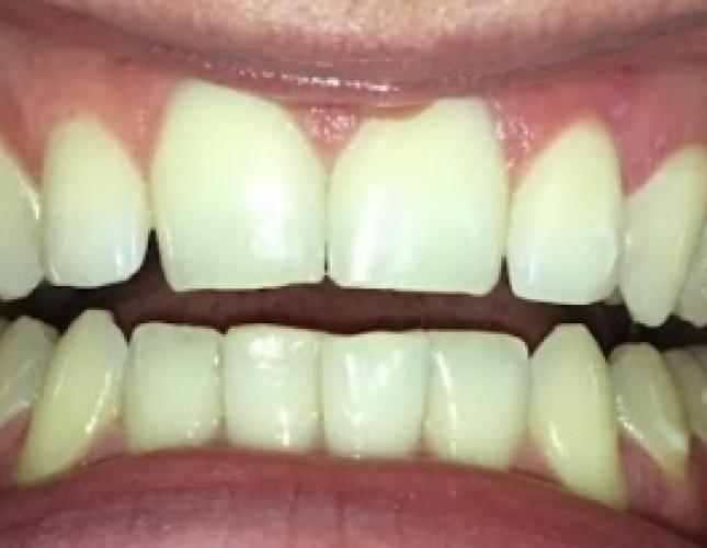 Invisalign Case 2 before