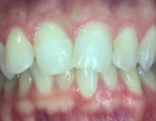 Invisalign Case 3 before