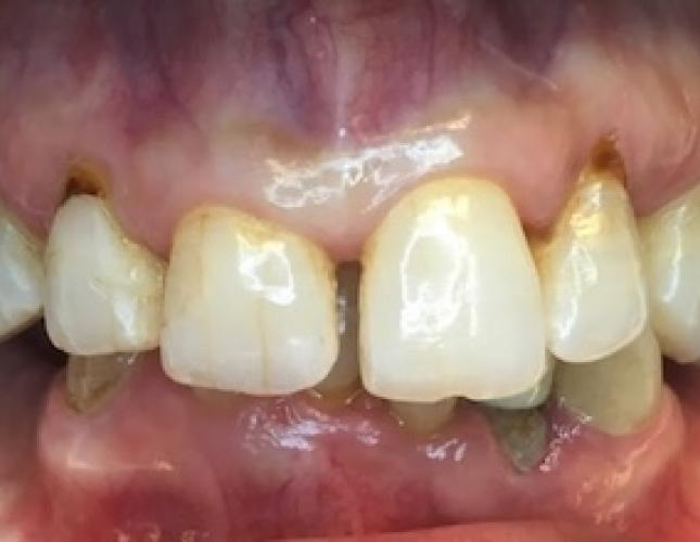 Crown & Bridge before Crown & Bridge before