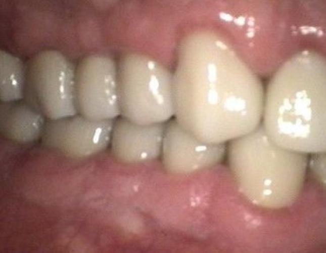 Crowns after