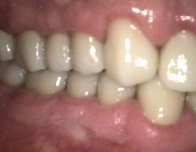 Crowns after
