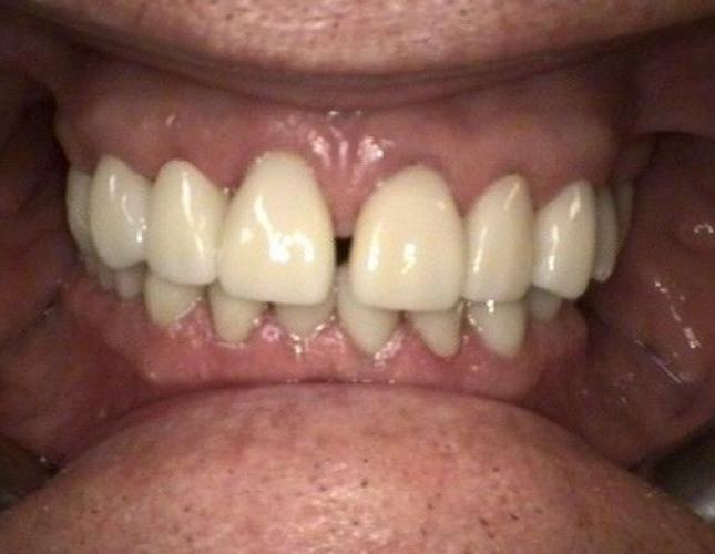 Crowns after Crowns after
