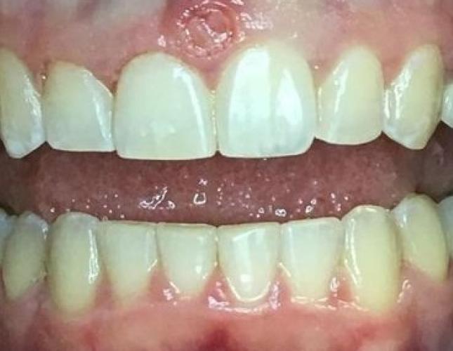 Invisalign after Invisalign after