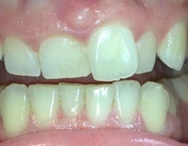 Invisalign before Invisalign before