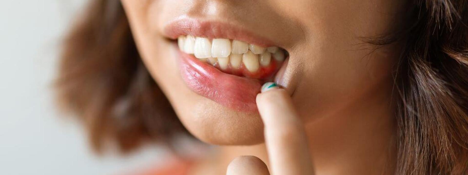 Causes of Gingivitis